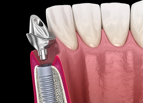 A 3D illustration of a dental implant’s abutment