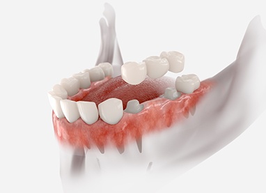 Digital illustration of a dental bridge