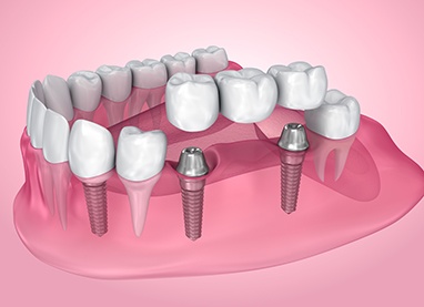 Illustration of a dental implant bridge